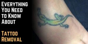 Everything You Need to Know About Tattoo Removal