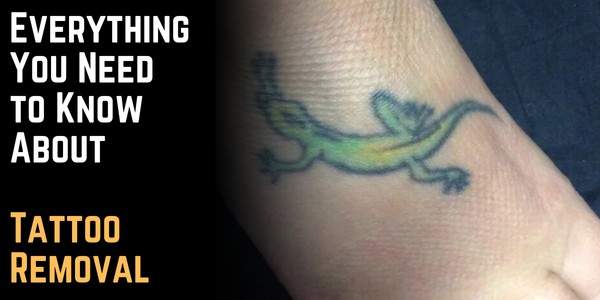 Everything You Need to Know About Tattoo Removal