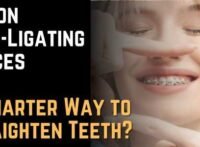 Damon Self-Ligating Braces A Smarter Way to Straighten Teeth