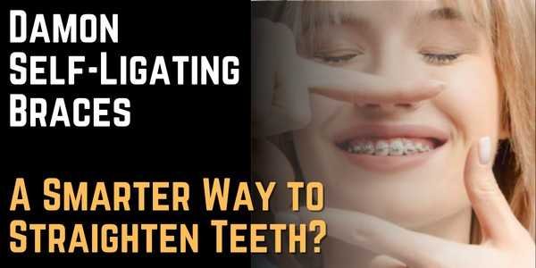 Damon Self-Ligating Braces A Smarter Way to Straighten Teeth 